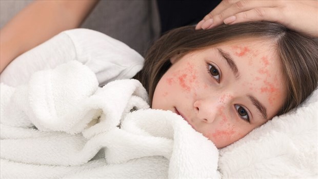 Prévention après des cas de rougeole dans la région de la Capitale-Nationale